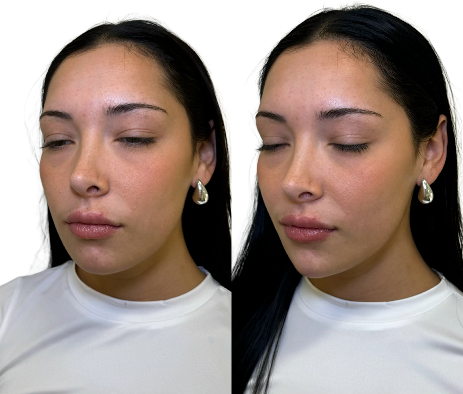 Dermal Fillers Before & After