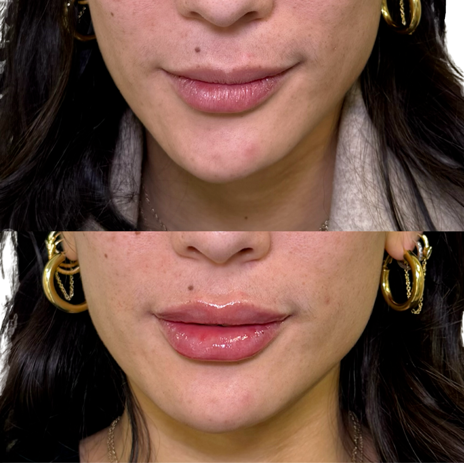 Dermal Fillers Before & After