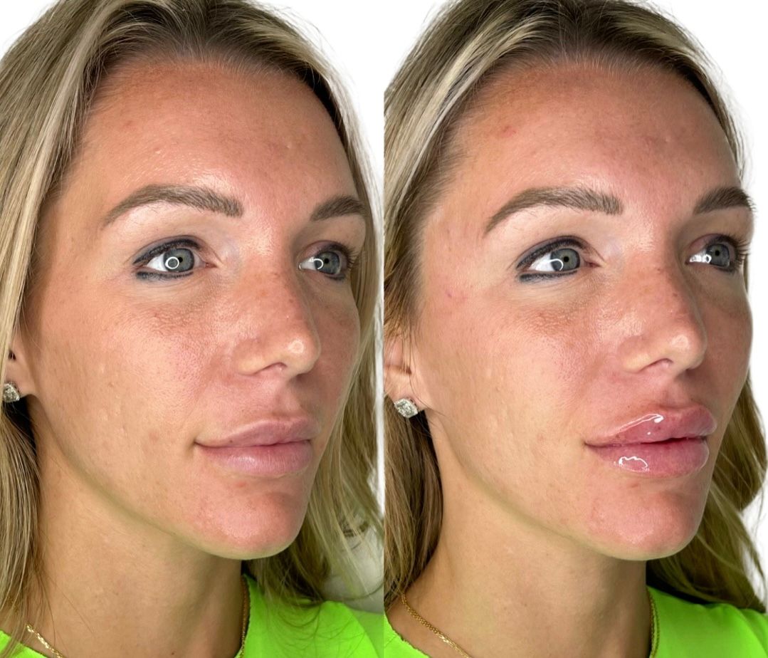 Dermal Fillers Before & After