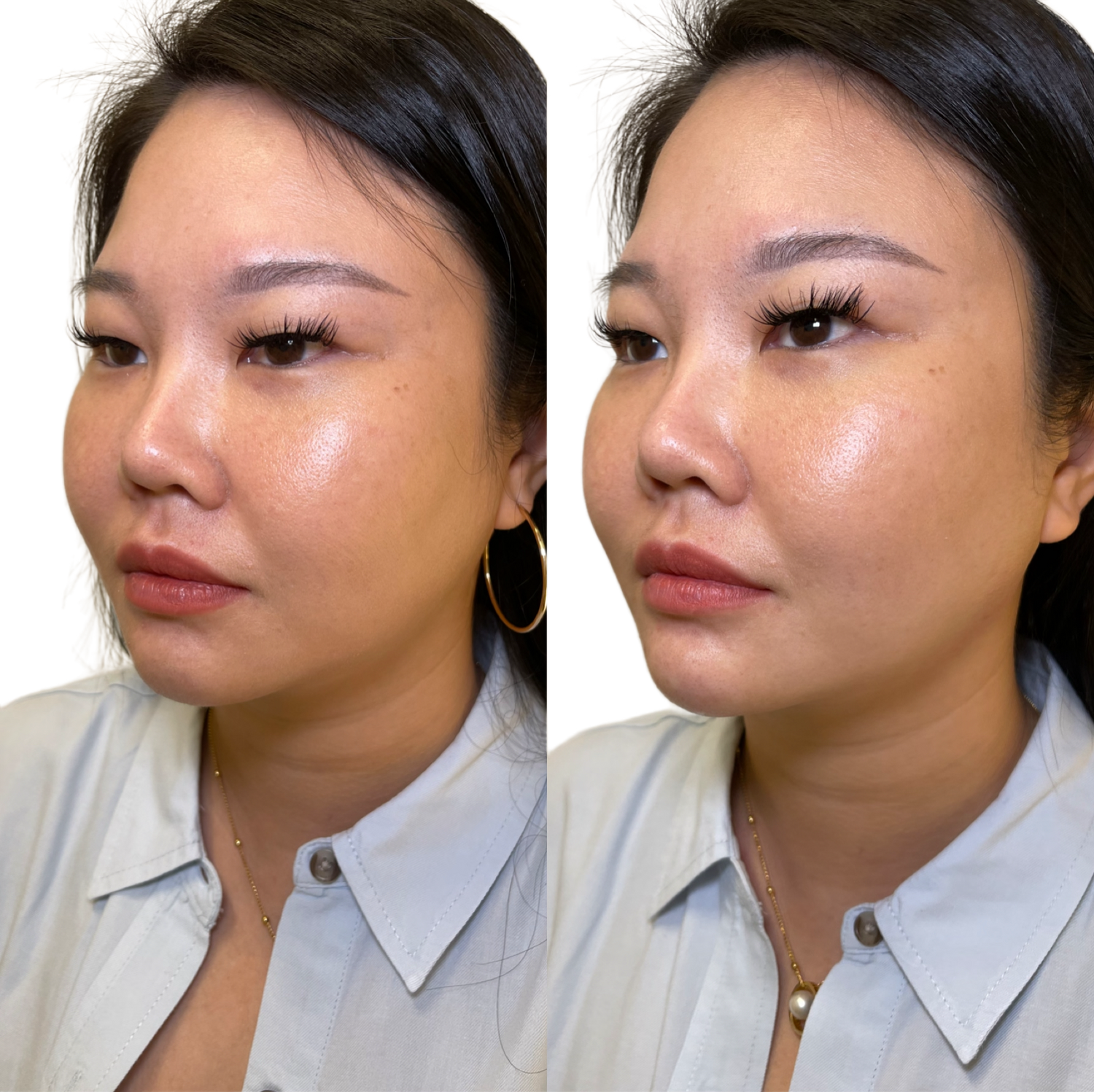 Dermal Fillers Before & After
