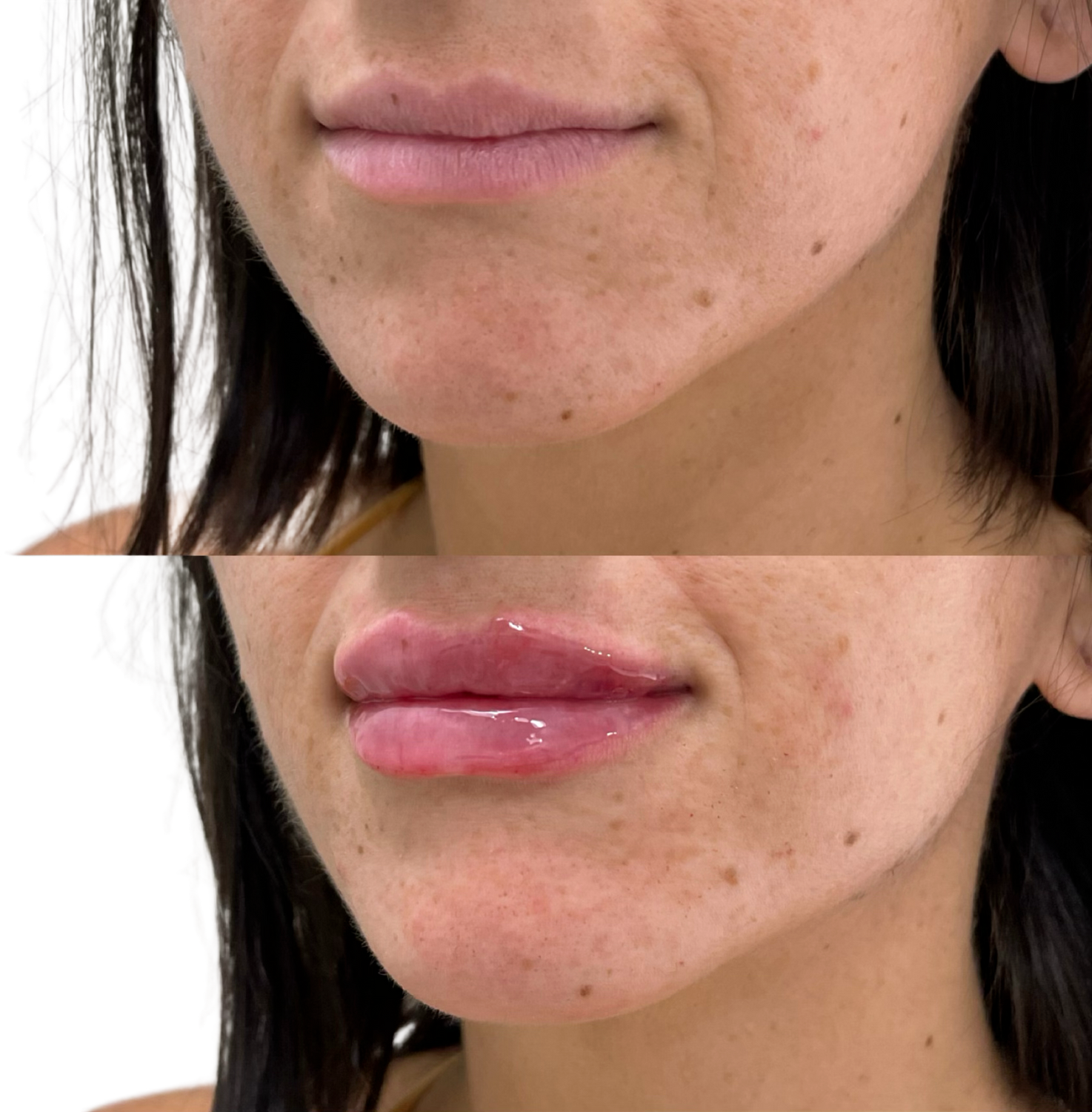 Dermal Fillers Before & After