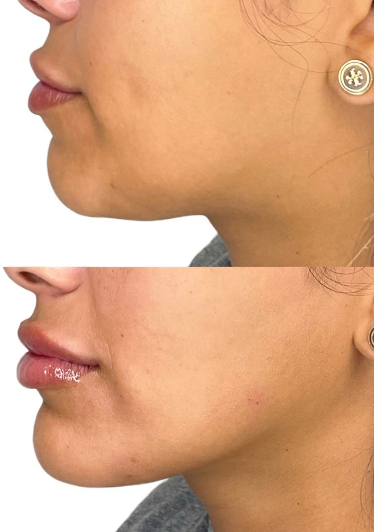 Dermal Fillers Before & After