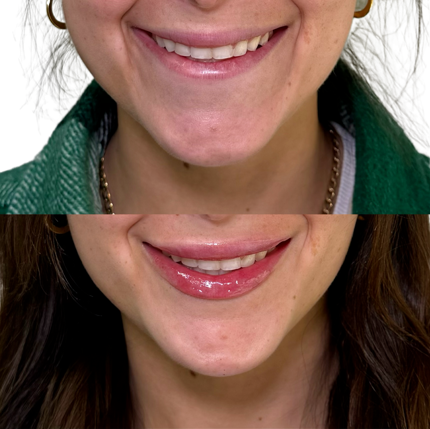 Dermal Fillers Before & After