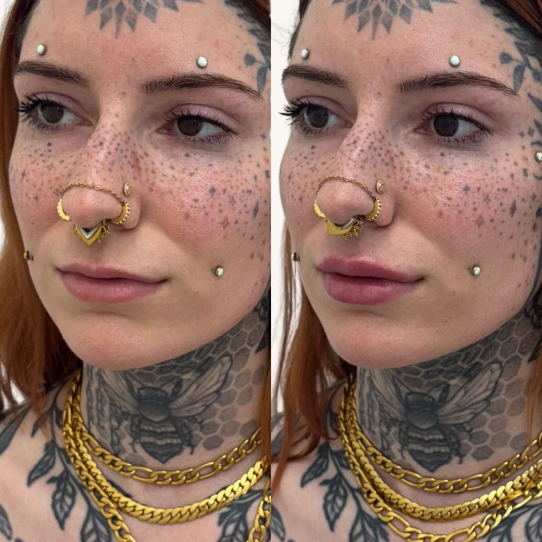 Dermal Fillers Before & After