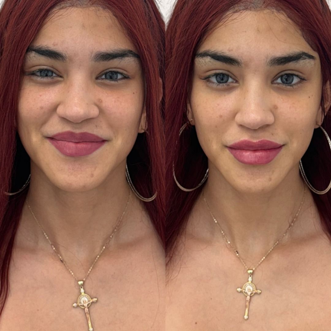 Dermal Fillers Before & After