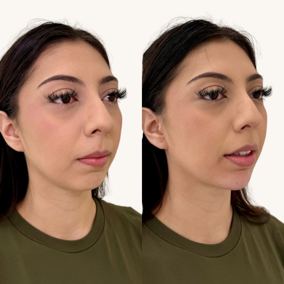 Dermal Fillers Before & After
