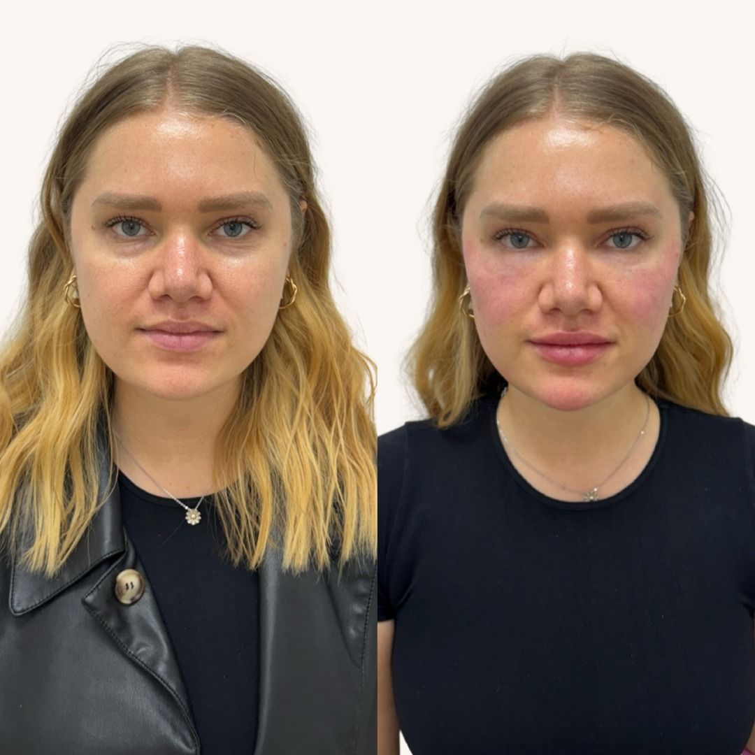 Dermal Fillers Before & After