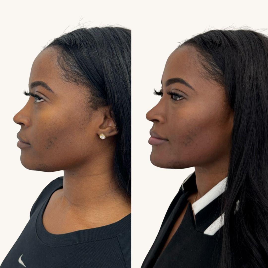 Dermal Fillers Before & After