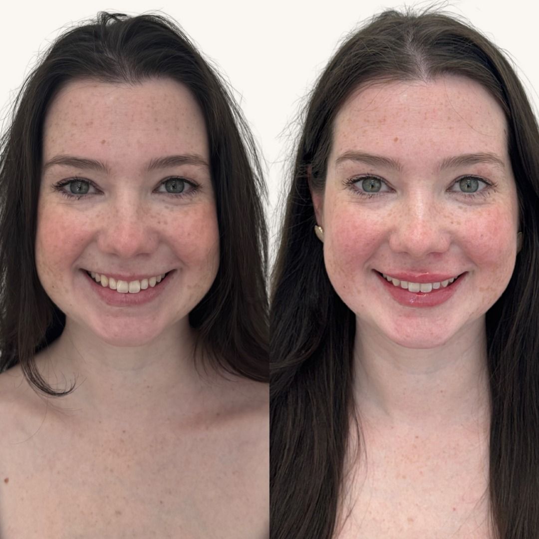 Dermal Fillers Before & After
