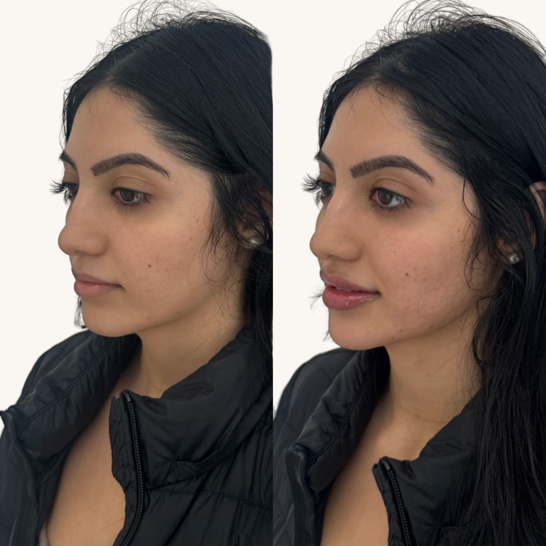 Dermal Fillers Before & After