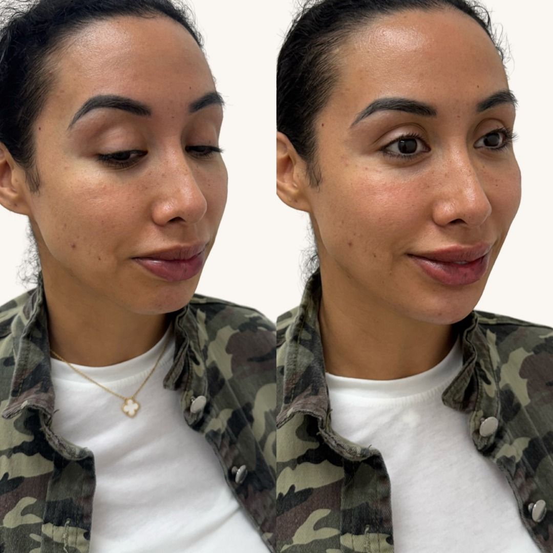 Dermal Fillers Before & After