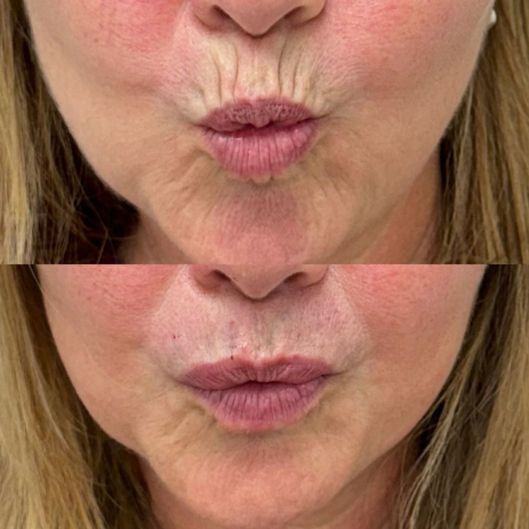 Dermal Fillers Before & After