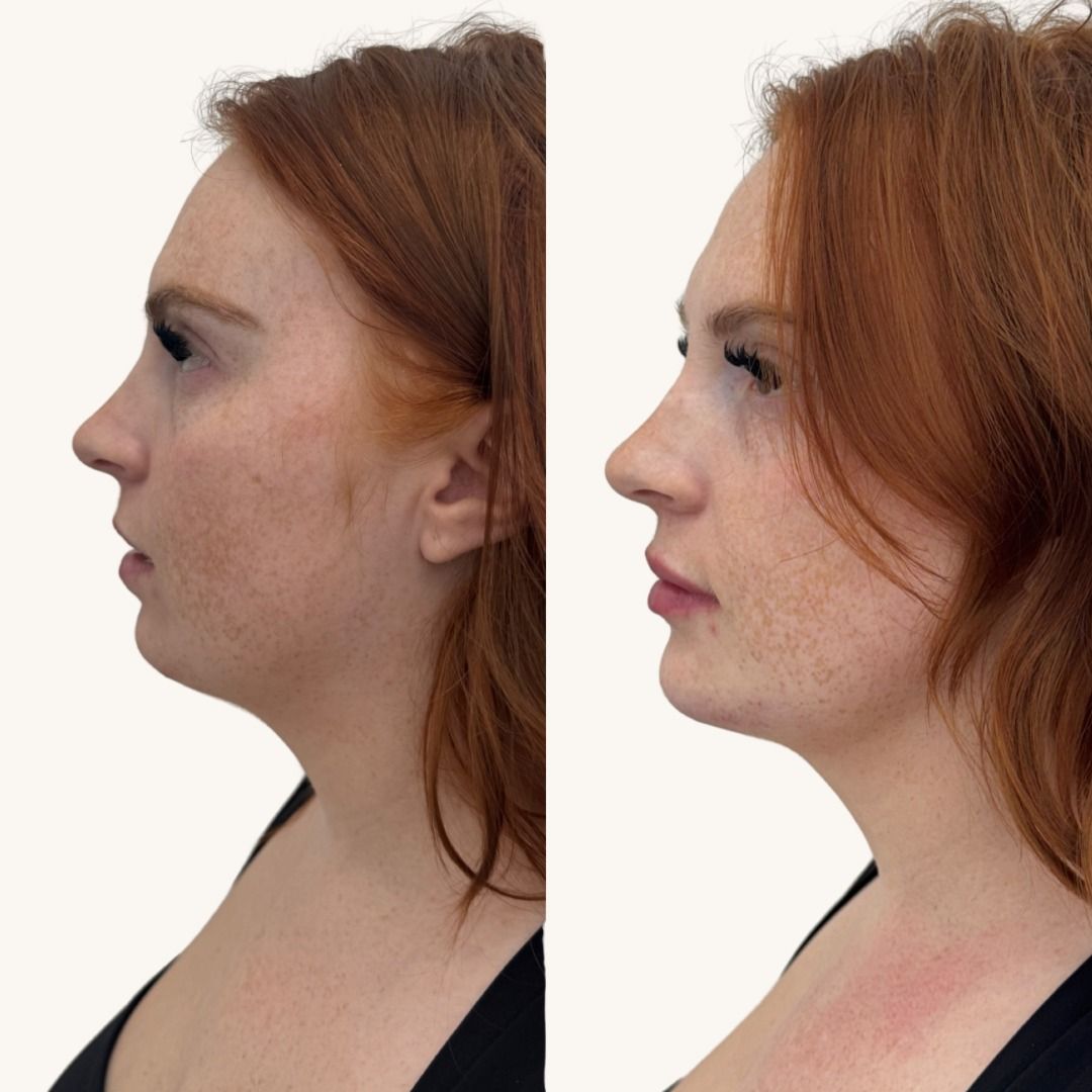 Dermal Fillers Before & After