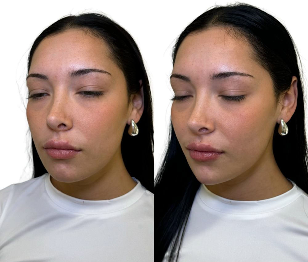 Juvederm Before & After
