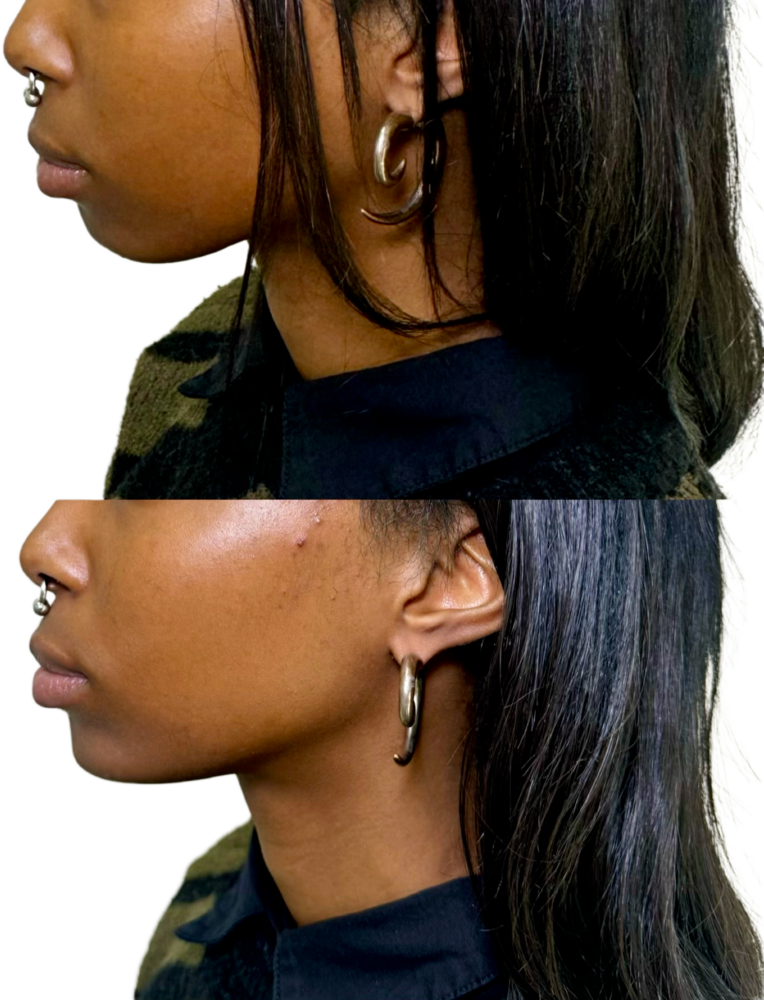 Juvederm Before & After