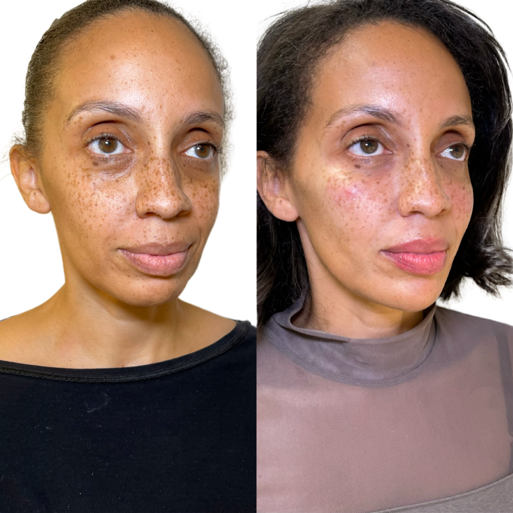 Juvederm Before & After