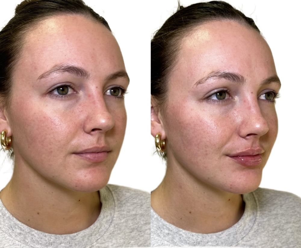 Juvederm Before & After