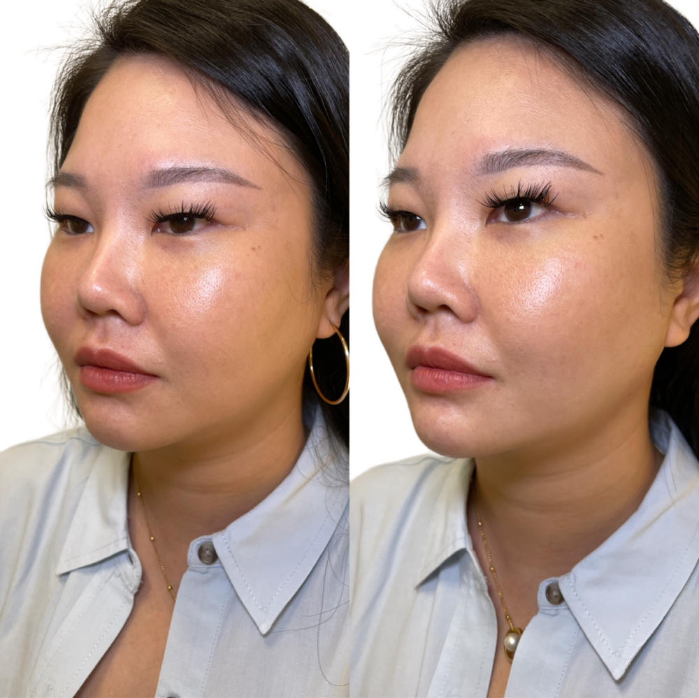 Juvederm Before & After