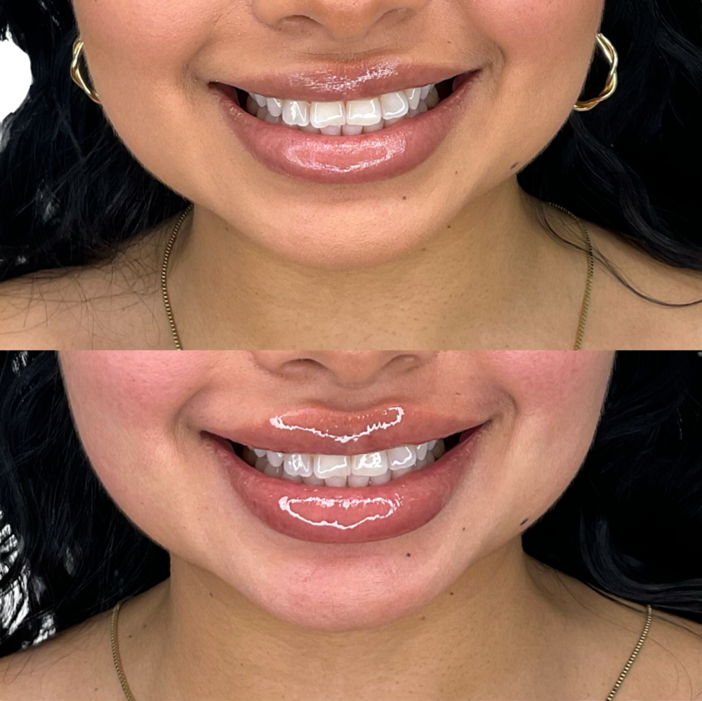 Juvederm Before & After