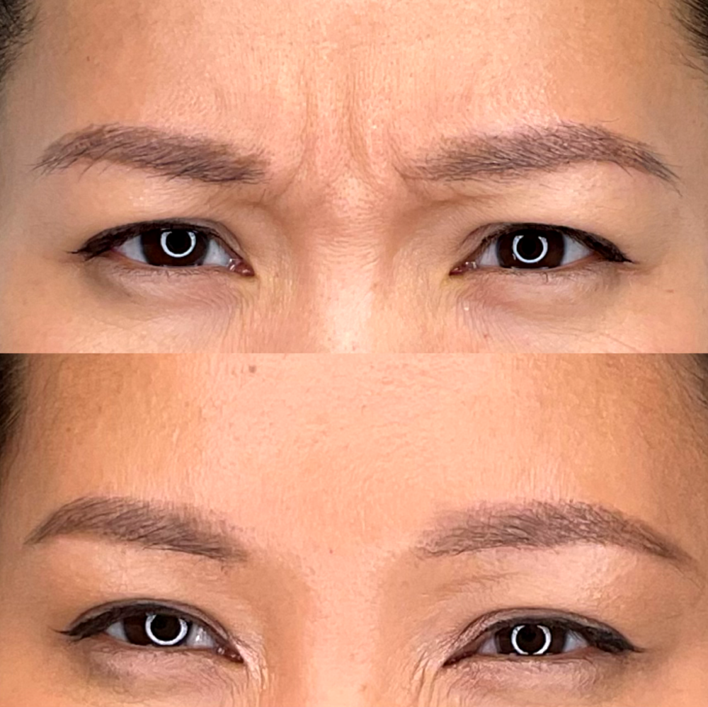 Botox Before & After