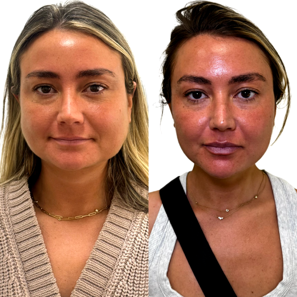 Botox Before & After