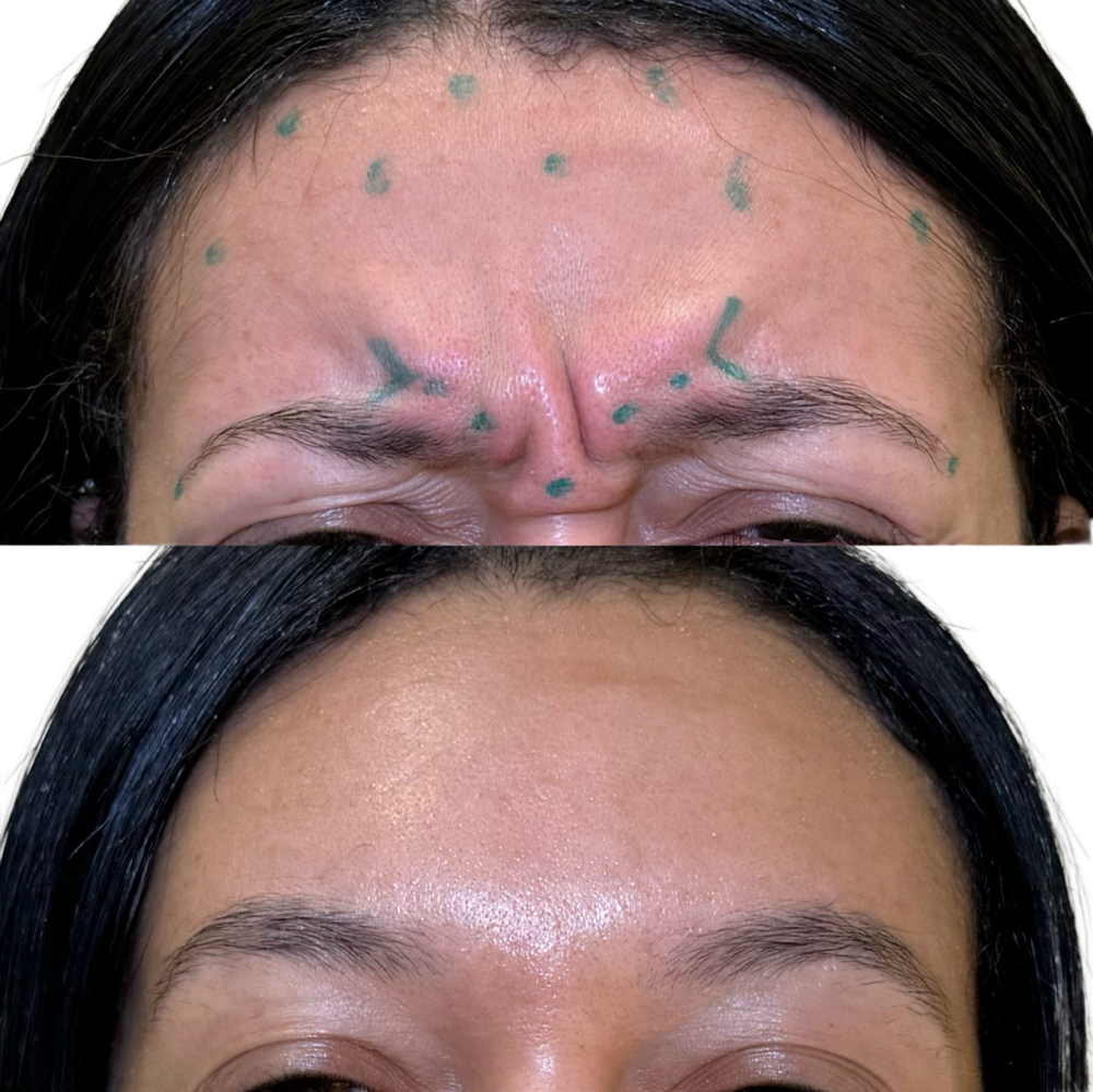 Botox Before & After