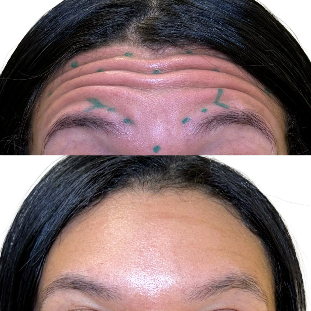 Botox Before & After