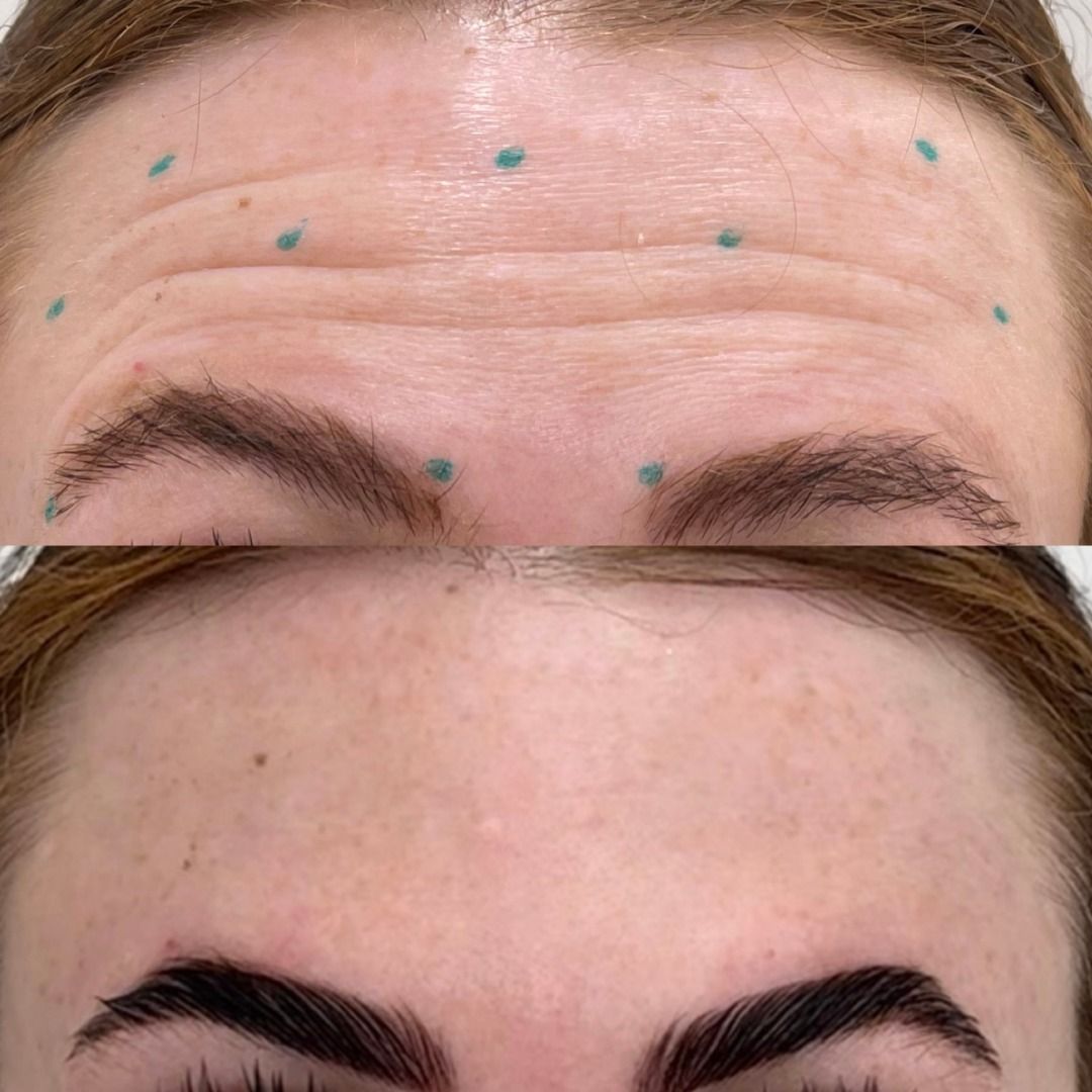Botox Before & After