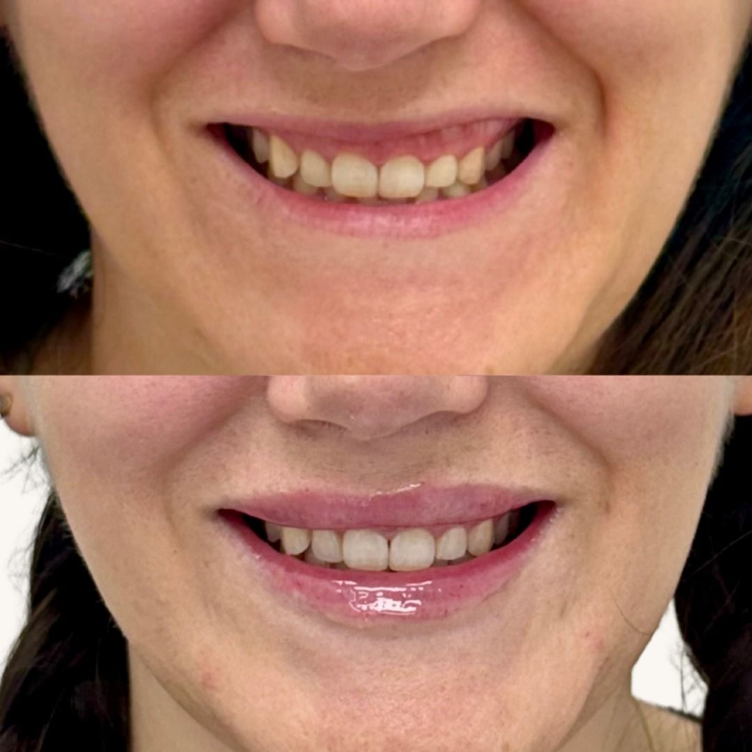 Botox Before & After