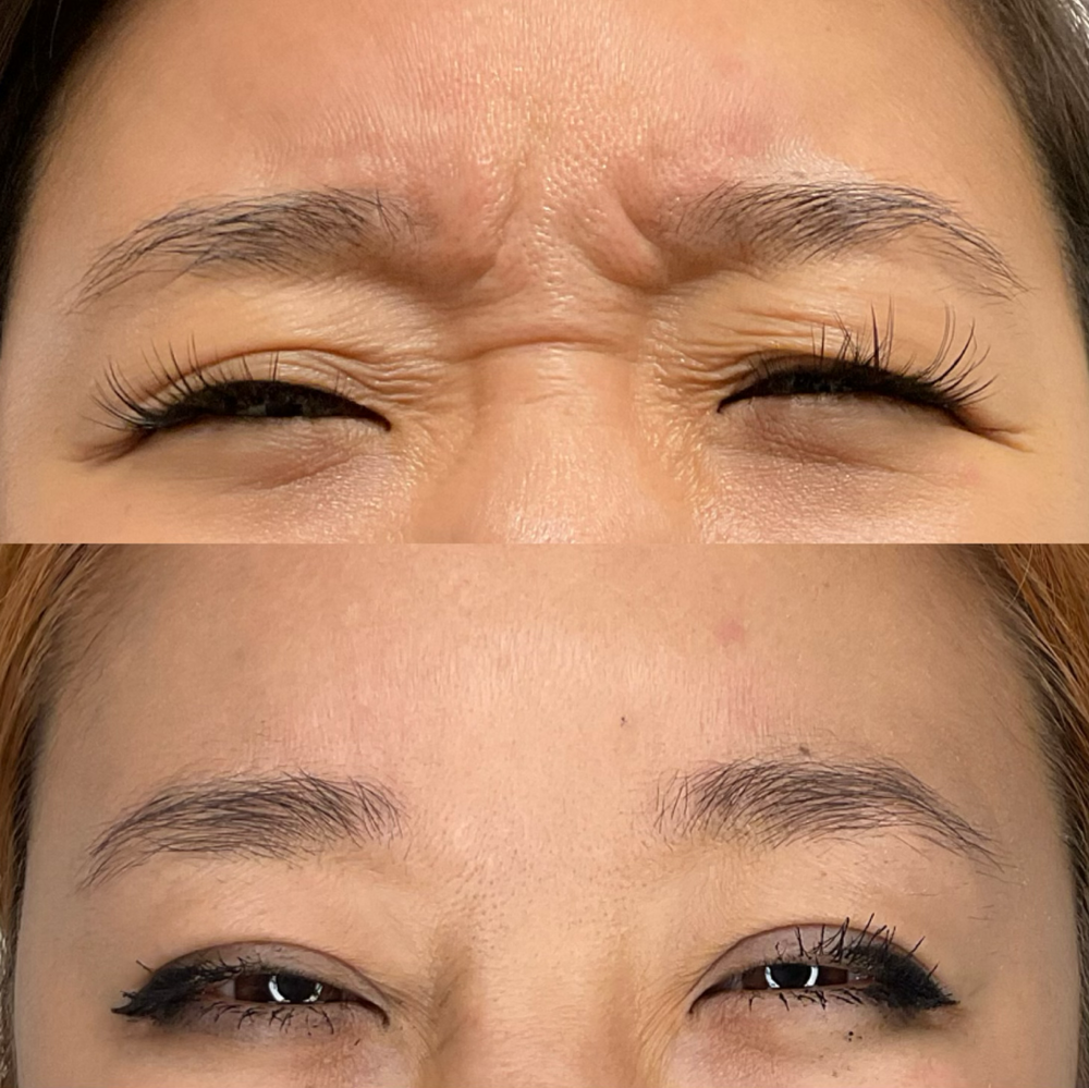 Dysport Before & After