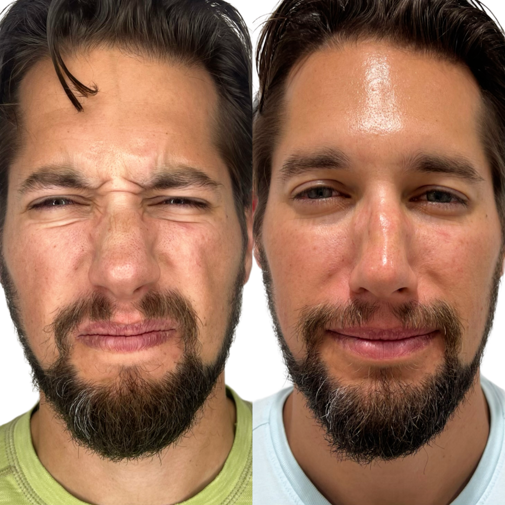 Dysport Before & After