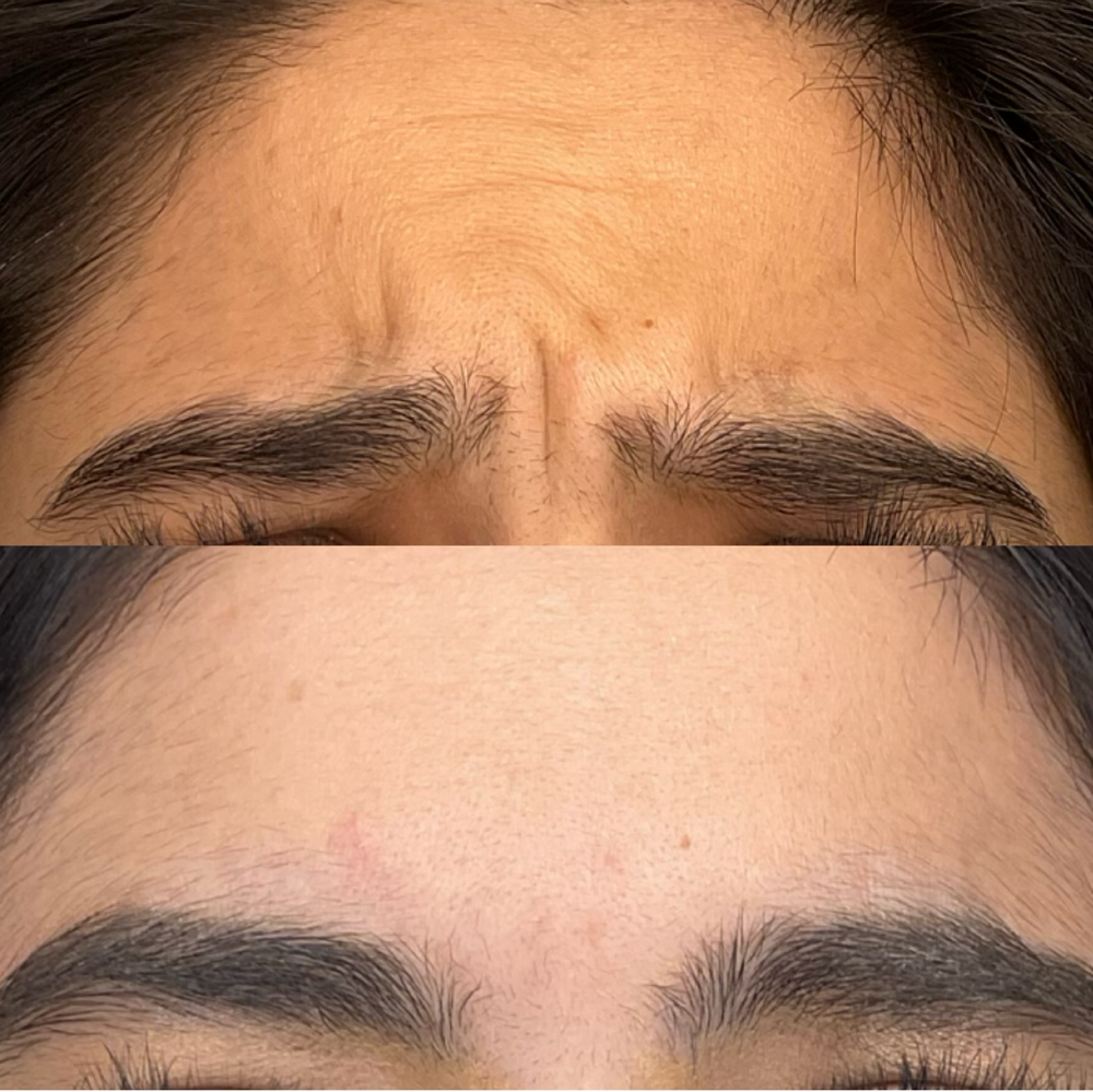 Dysport Before & After