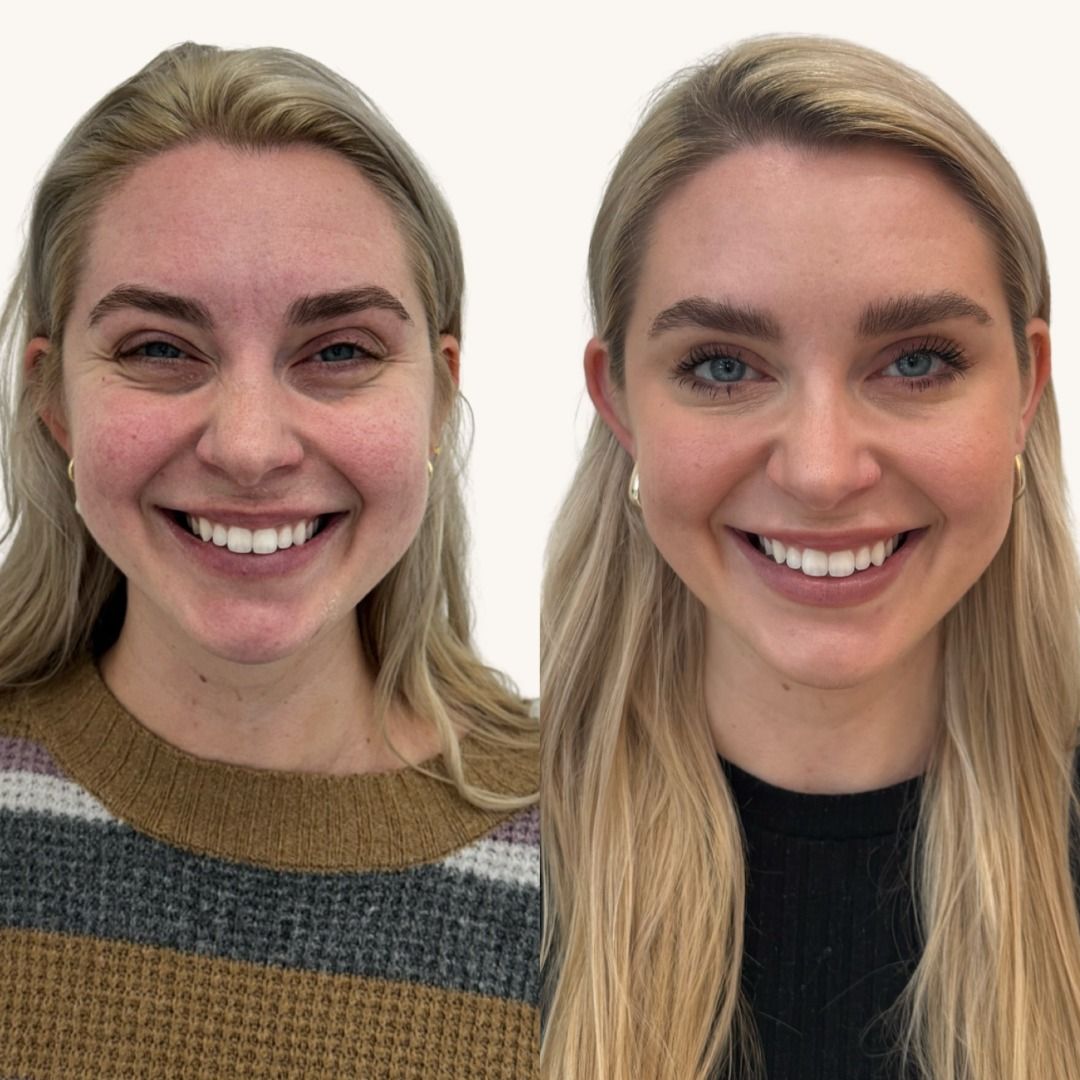 Dysport Before & After