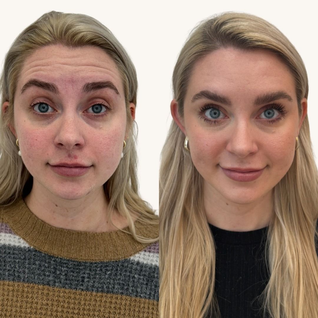 Dysport Before & After