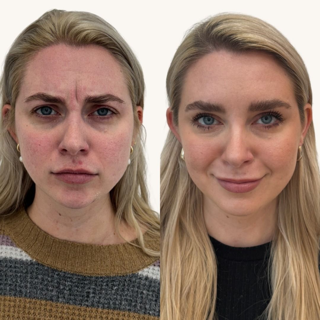 Dysport Before & After