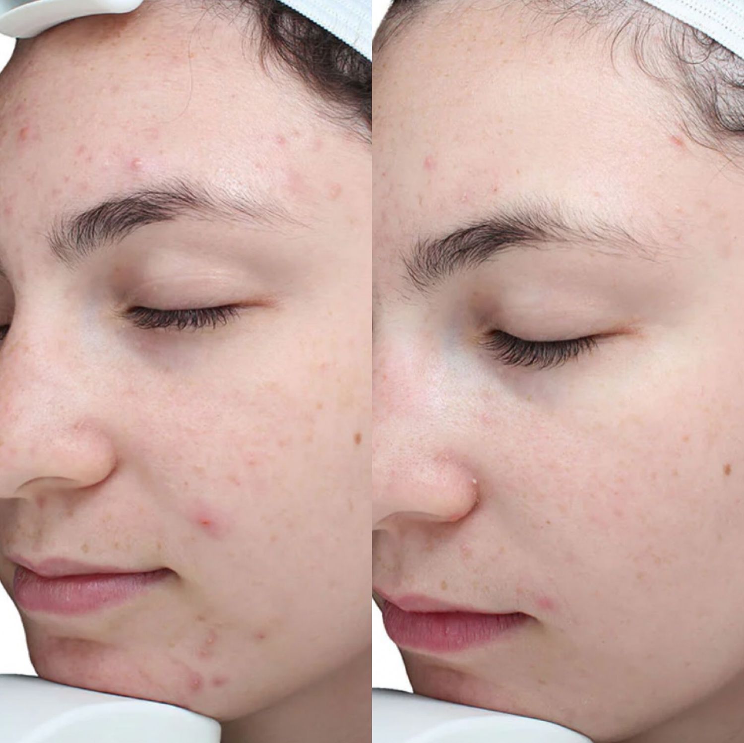 Chemical Peel Before & After