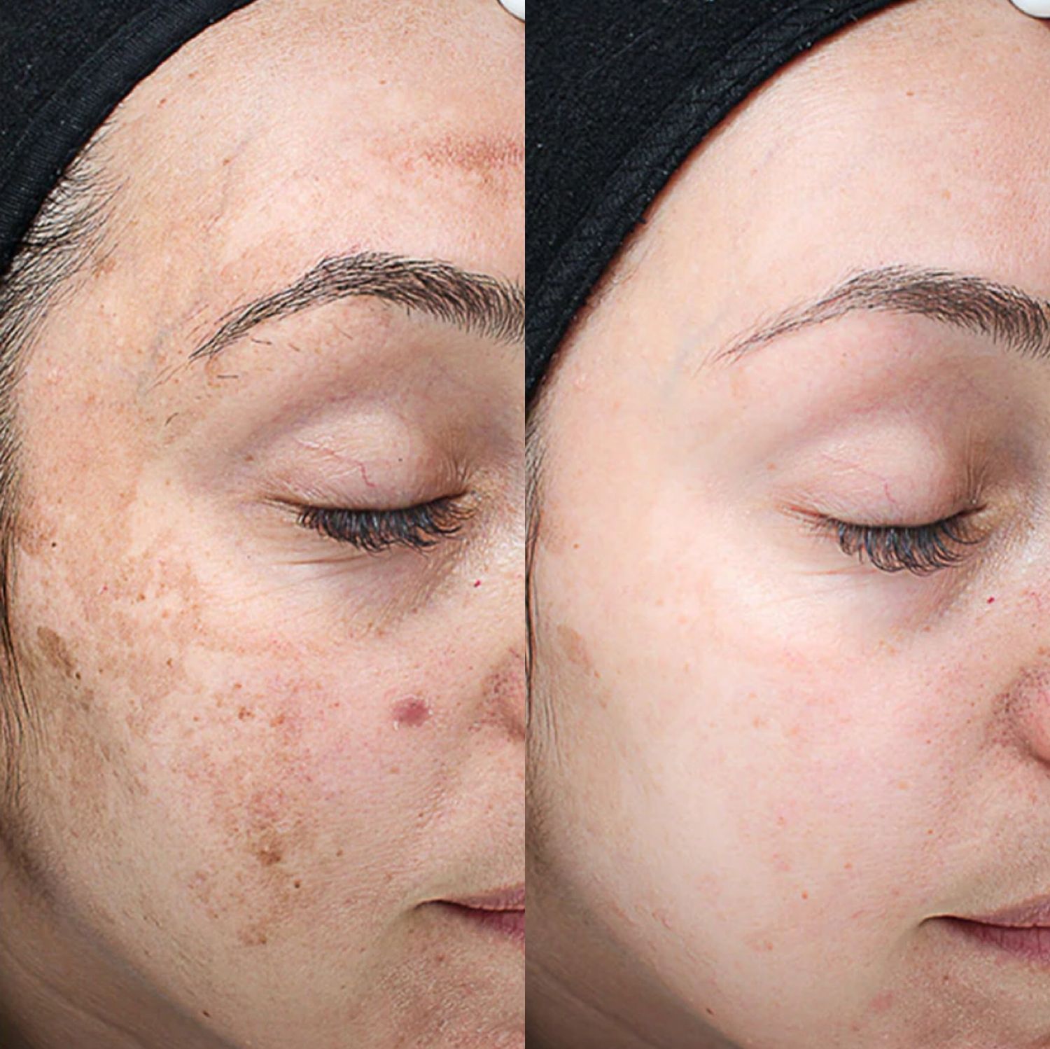 Chemical Peel Before & After