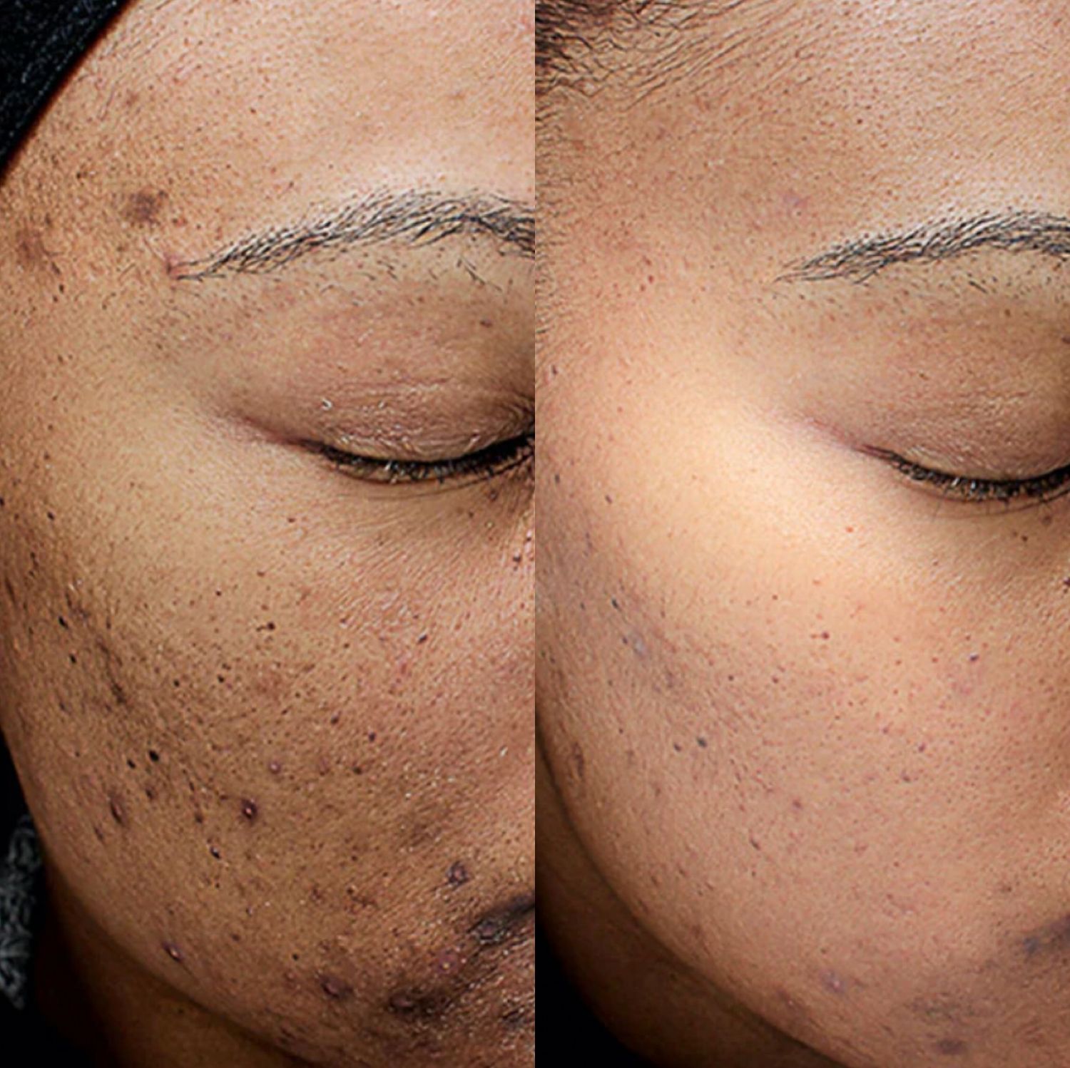 Chemical Peel Before & After