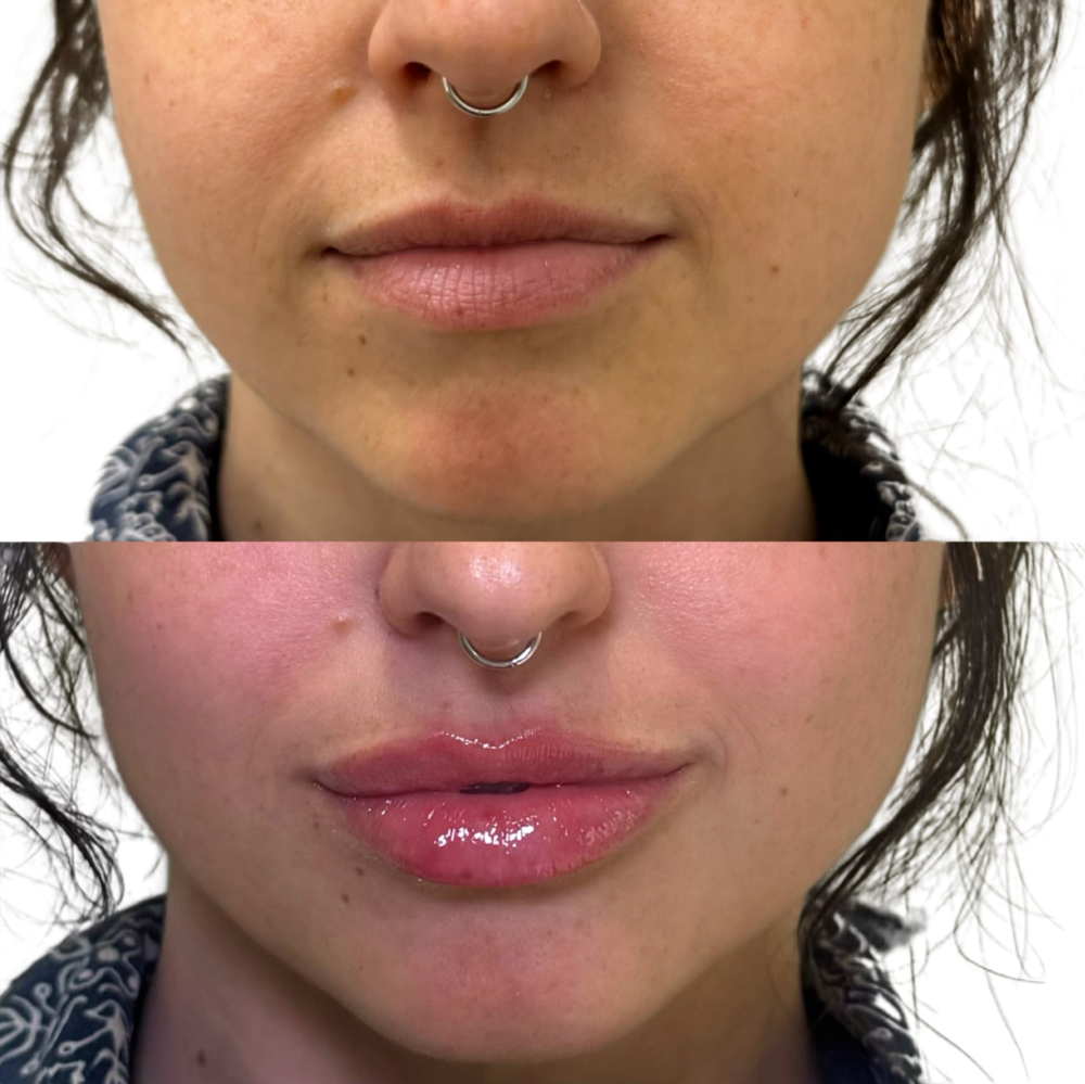 Restylane Before & After