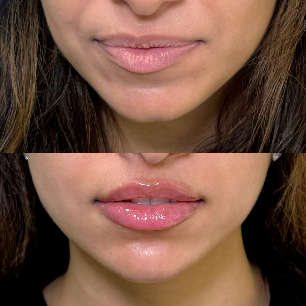 Restylane Before & After