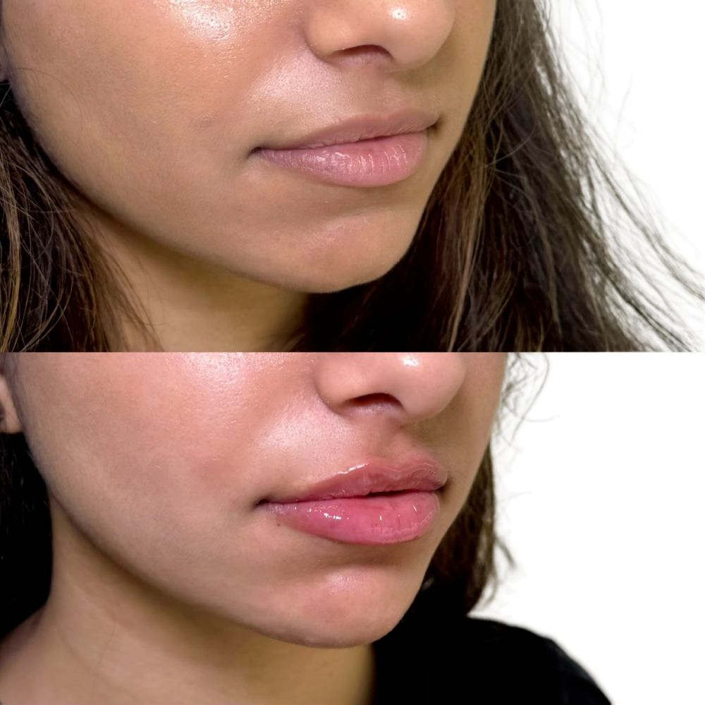 Restylane Before & After