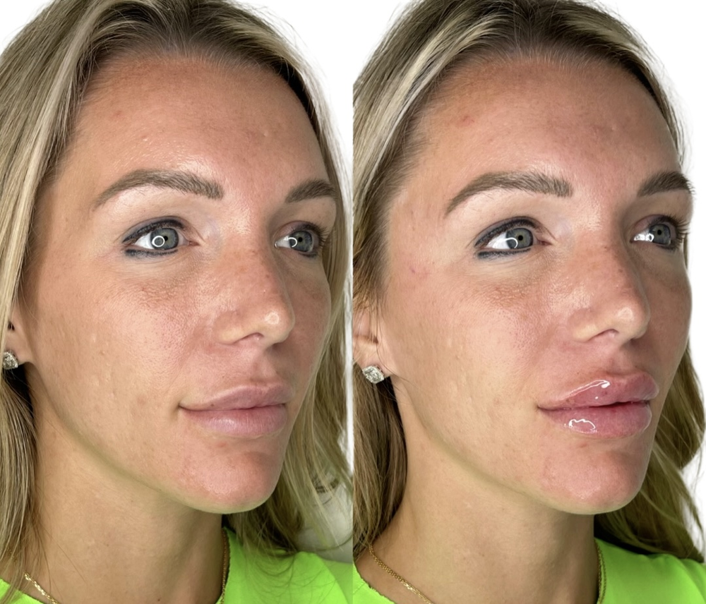 Restylane Before & After