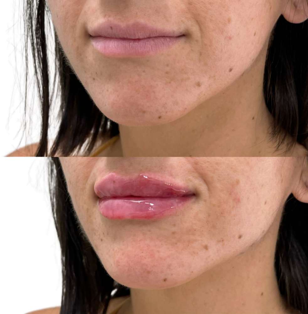 Restylane Before & After