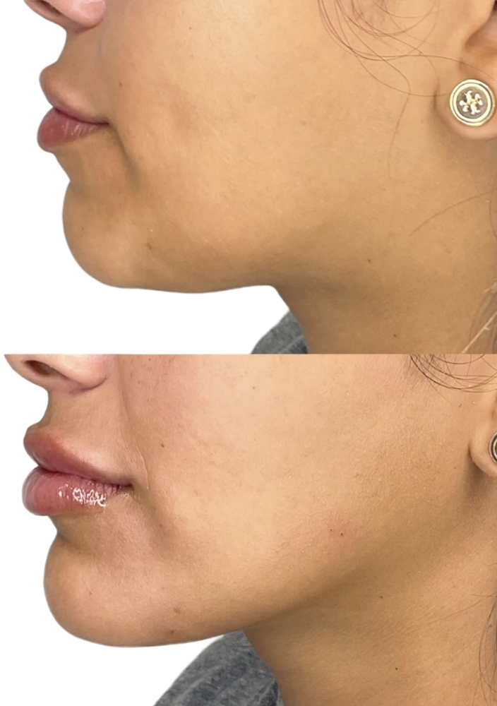Restylane Before & After