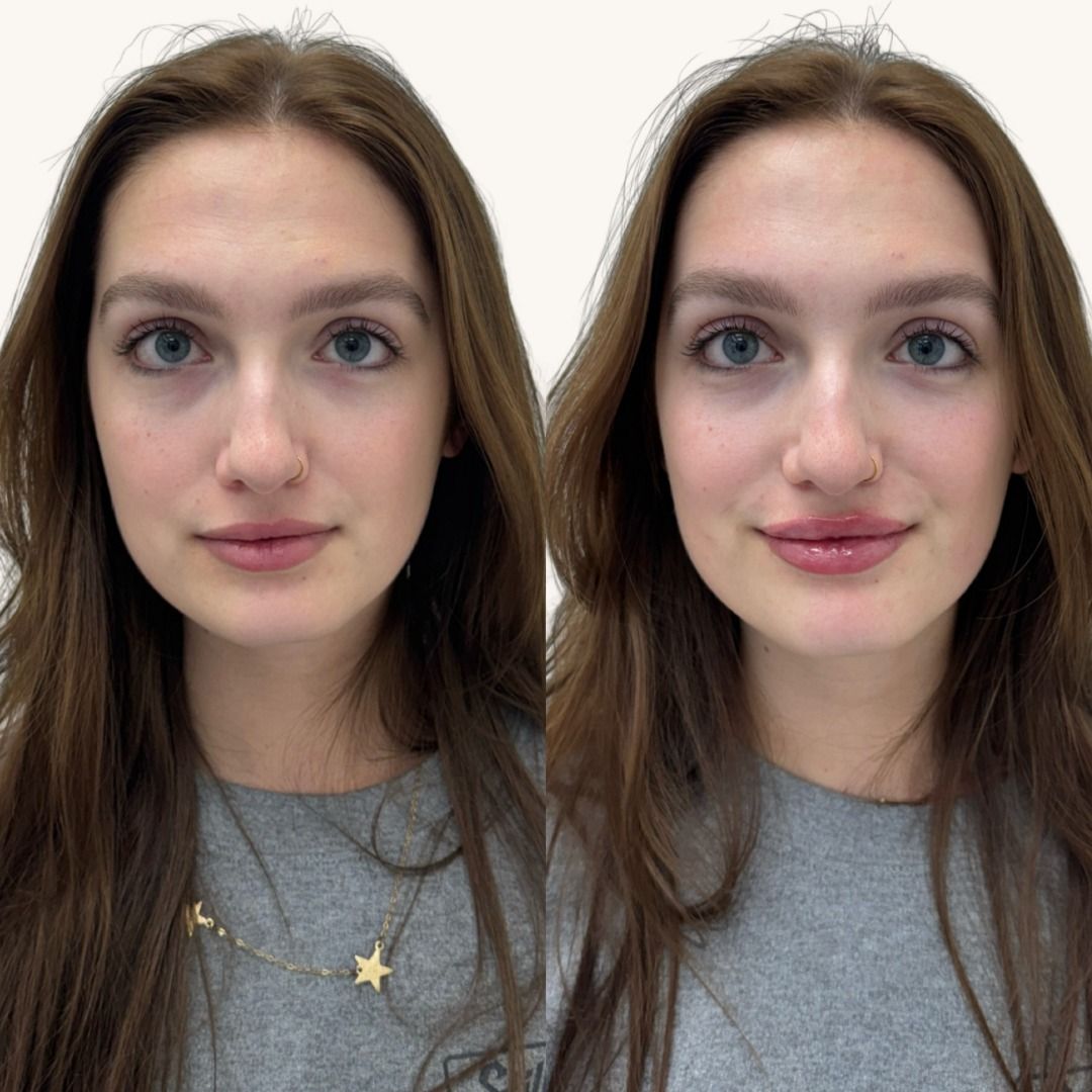 Restylane Before & After