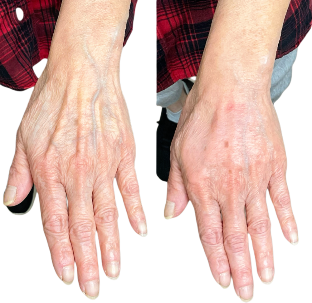 Biostimulators Before & After