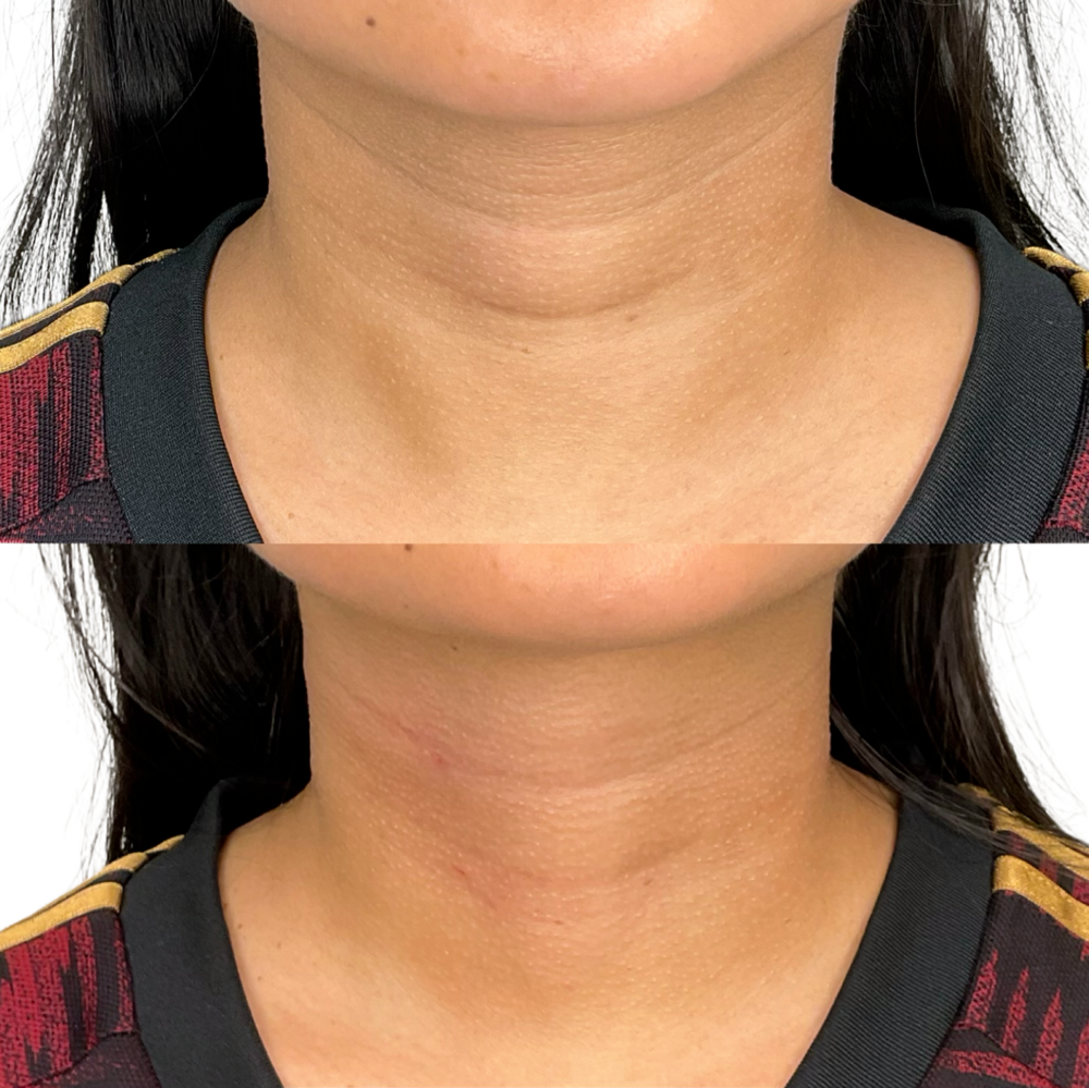Biostimulators Before & After