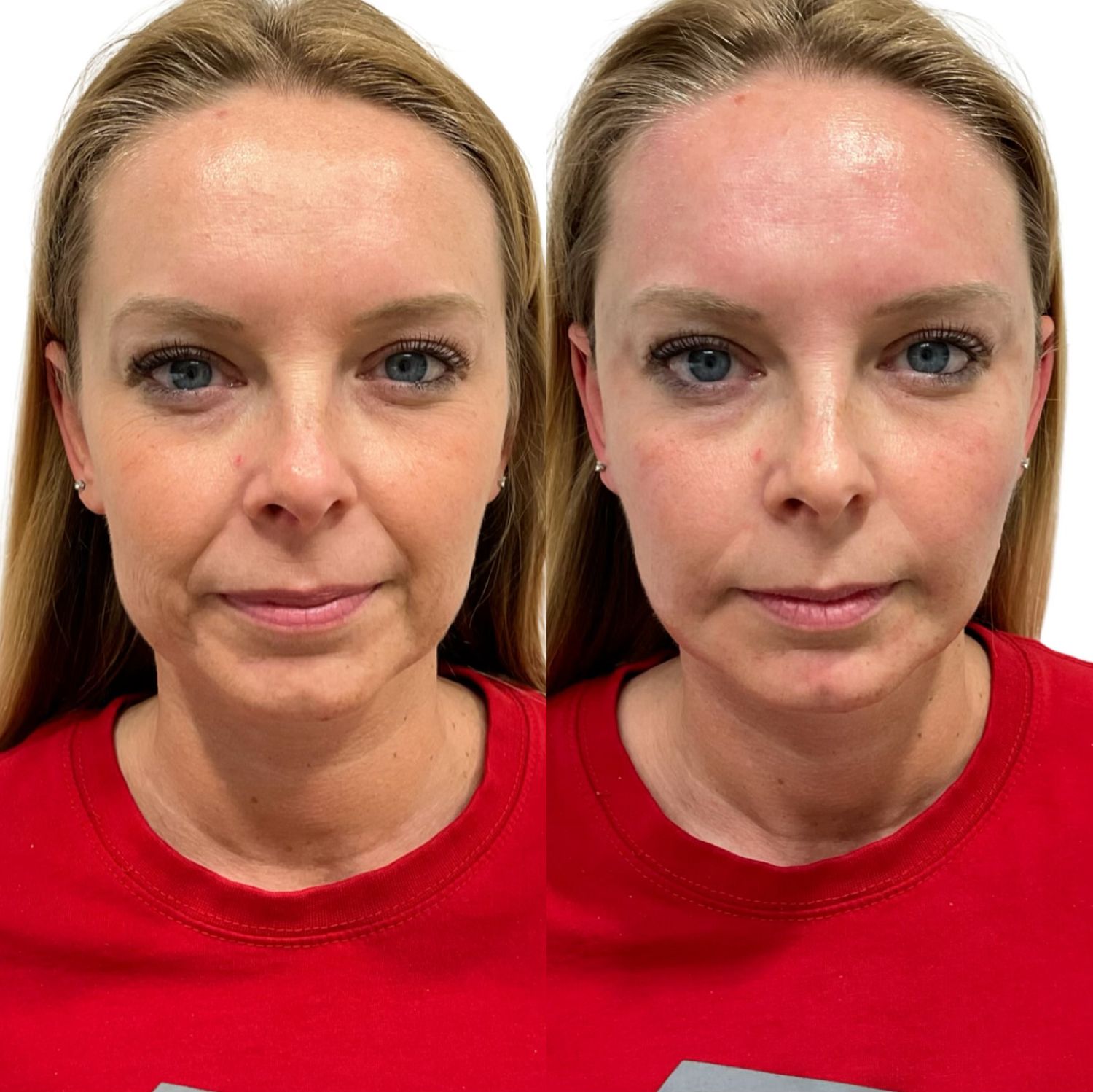 Sculptra Before & After