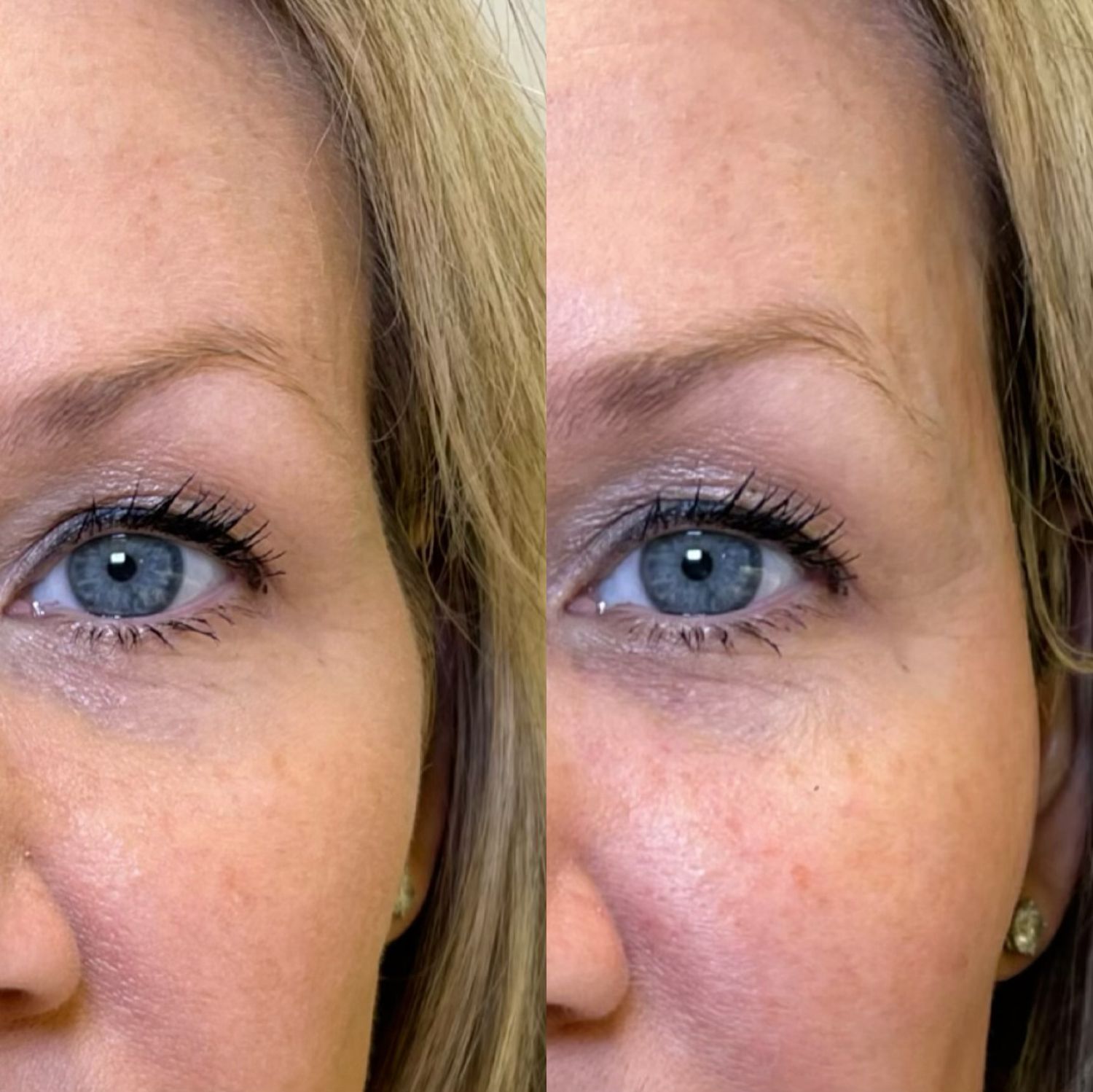 Sculptra Before & After