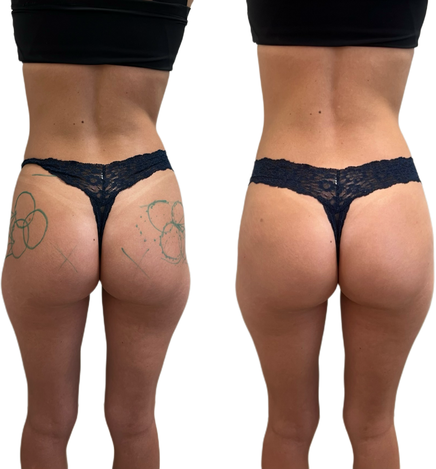 Sculptra Before & After